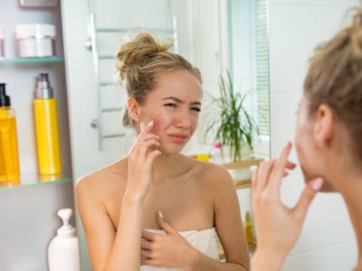 WIST JE DAT 85% VAN DE JONGEREN LAST HEBBEN VAN ACNÉ?