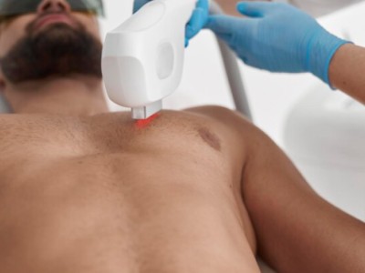 Laserontharing Mannen