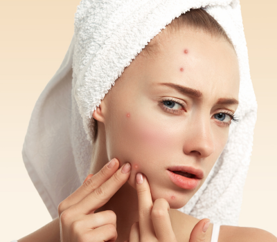 Puistjes na een gezichtsbehandeling?