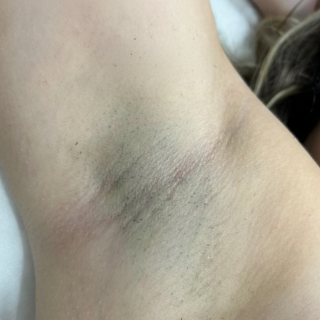 before laserontharing